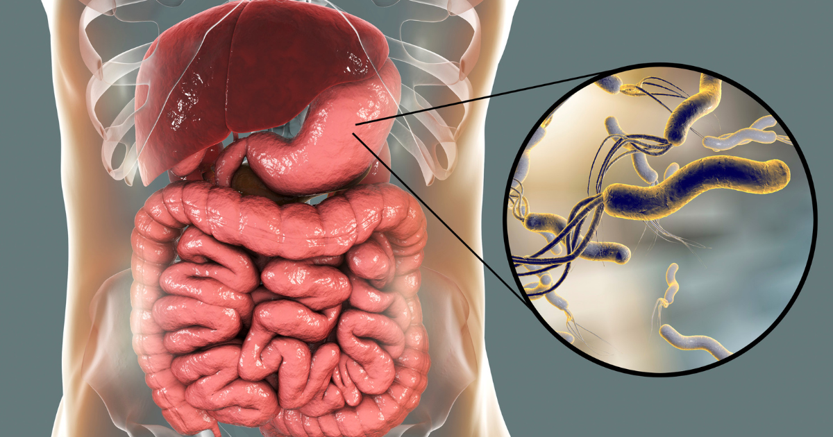 H. Pylori: Sintomas, como ocorre a transmissão e o melhor tratamento